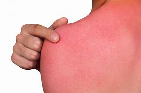 Image result for Girl Purple Sun Burn Shoulders