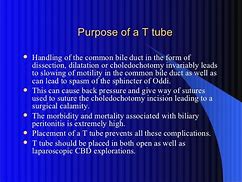 Image result for T-tube Bile Duct