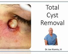 Image result for Sebaceous Cyst Surgery