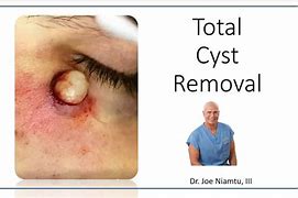 Image result for Sebaceous Cyst Removal Kit
