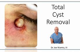 Image result for Sebaceous Cyst Belly Button