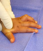 Image result for Camptodactyly Pinky Finger