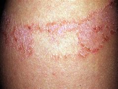 Image result for Contact Dermatitis Rashes