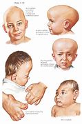 Image result for craniosynostosis causes