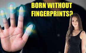 Image result for Born without Fingerprints