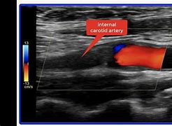 Image result for Ultrasound of Carotid Artery Blocked