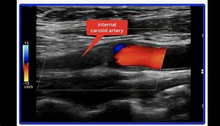 Image result for Carotid Artery Ultrasound Screening
