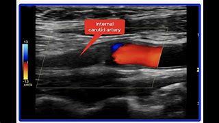Image result for Abnormal Carotid Ultrasound