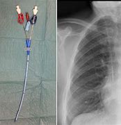 Image result for Dialysis Chest Catheter
