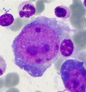 Image result for Fifth Disease Parvovirus B19