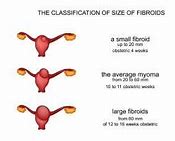 Image result for 4 Cm Uterine Fibroid