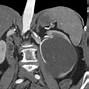 Image result for Complex Kidney Cyst with Septations