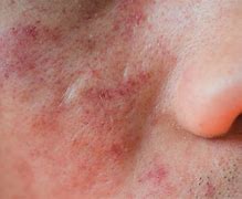 Image result for Red Sores On Face