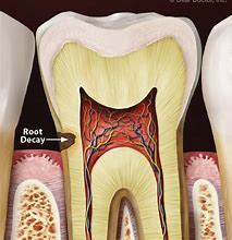 Image result for Tooth Root Decay