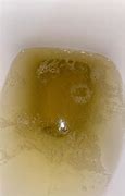 Image result for Bubbles in Urine Diabetes