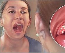 Image result for Molluscum Removal