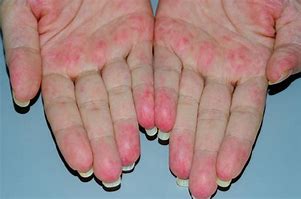 Image result for Petechiae On Fingers