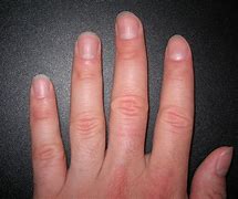 Image result for Image of Fingernails Turning Blue