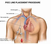 Image result for PICC Line Infusion