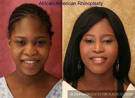 Image result for African American Rhinoplasty Before and After