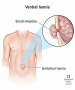 Image result for What Does a 5 Cm Hernia Look Like