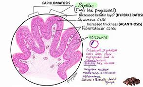 Image result for Squamous Papilloma Histology
