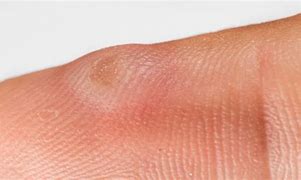 Image result for Skin Warts On Hands