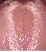 Image result for Erythematous Candidiasis
