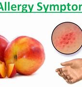 Image result for Peach Allergy Baby