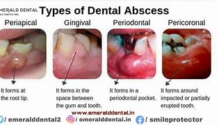 Image result for Abscess Popping