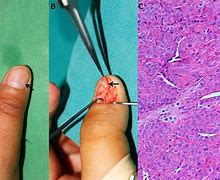 Image result for How Big Is 7Mm Tumor