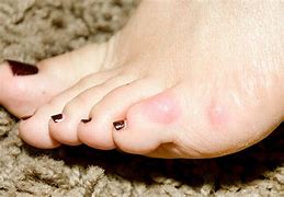 Image result for Sharp Pain in Pinky Toe