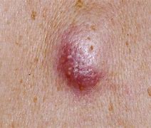 Image result for Sebaceous Cyst Burst