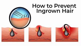Image result for Ingrown Hair On Face