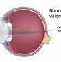 Image result for Picture of Astigmatism