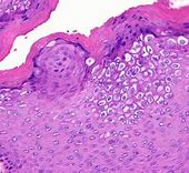 Image result for HPV Condyloma Acuminatum
