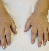 Image result for Oligoarthritis