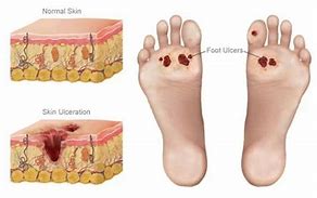 Image result for Ankle Ulcer Pain Relief