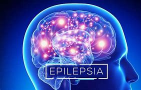 Image result for epilepsia