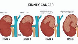 Image result for Kidney Lesion Size