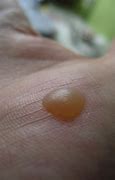 Image result for Chest Warts