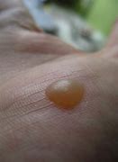 Image result for Types of Warts On Feet