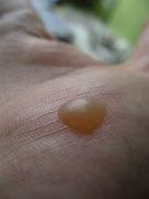 Image result for All Types of Warts
