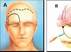 Image result for Meningioma Sugery