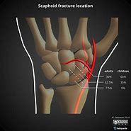 Image result for Scaphoid Fracture