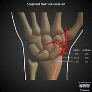 Image result for Wrist Fracture Scaphoid Bone