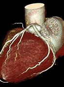 Image result for CT Coronary Angiogram