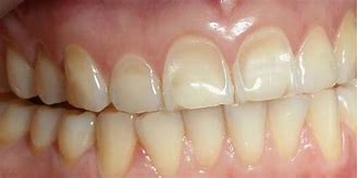 Image result for Esposed Dentin