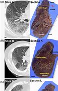 Image result for Lung Cancer Postmortm