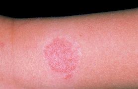 Image result for Children Skin Diseases